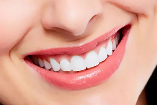 Smile Makeover