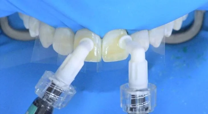 Resin Infiltration