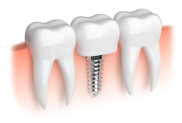 Dental Implant
