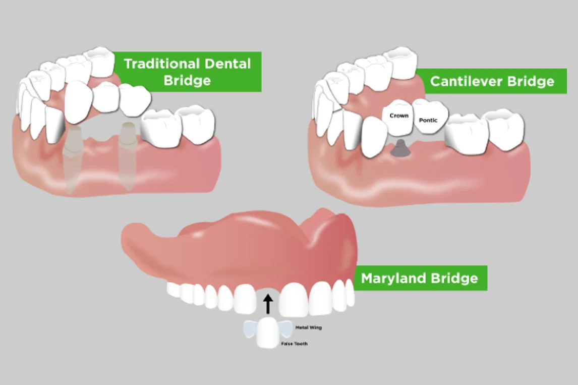 Dental Bridge