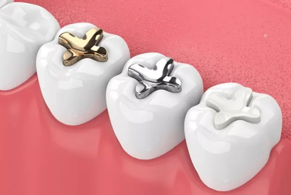 Dental Fillings