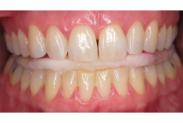 Dental Splint Therapy