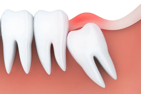 Wisdom Tooth Extraction