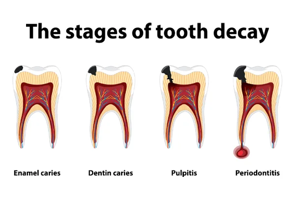 Tooth Decay