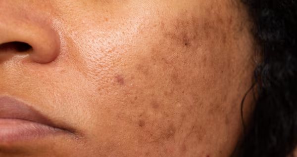 Pigmentation