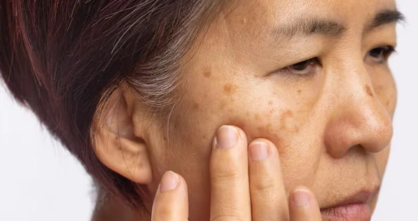 Melasma Treatment